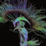 Diffusion Tensor Image (DTI) van baansystemen in het brein